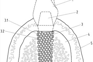 具有良好成骨效能的人工牙的制備方法